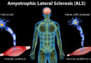 ELA, Esclerosis Lateral Amiotrófica: Causas, síntomas y tratamiento
