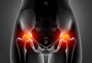 Osteoporosis: Se producen 90 fracturas de cadera por día