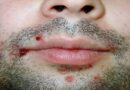 Herpes labial: Causas, síntomas y tratamiento