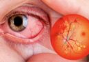 Ceguera por diabetes: Una afección silenciosa que se puede prevenir